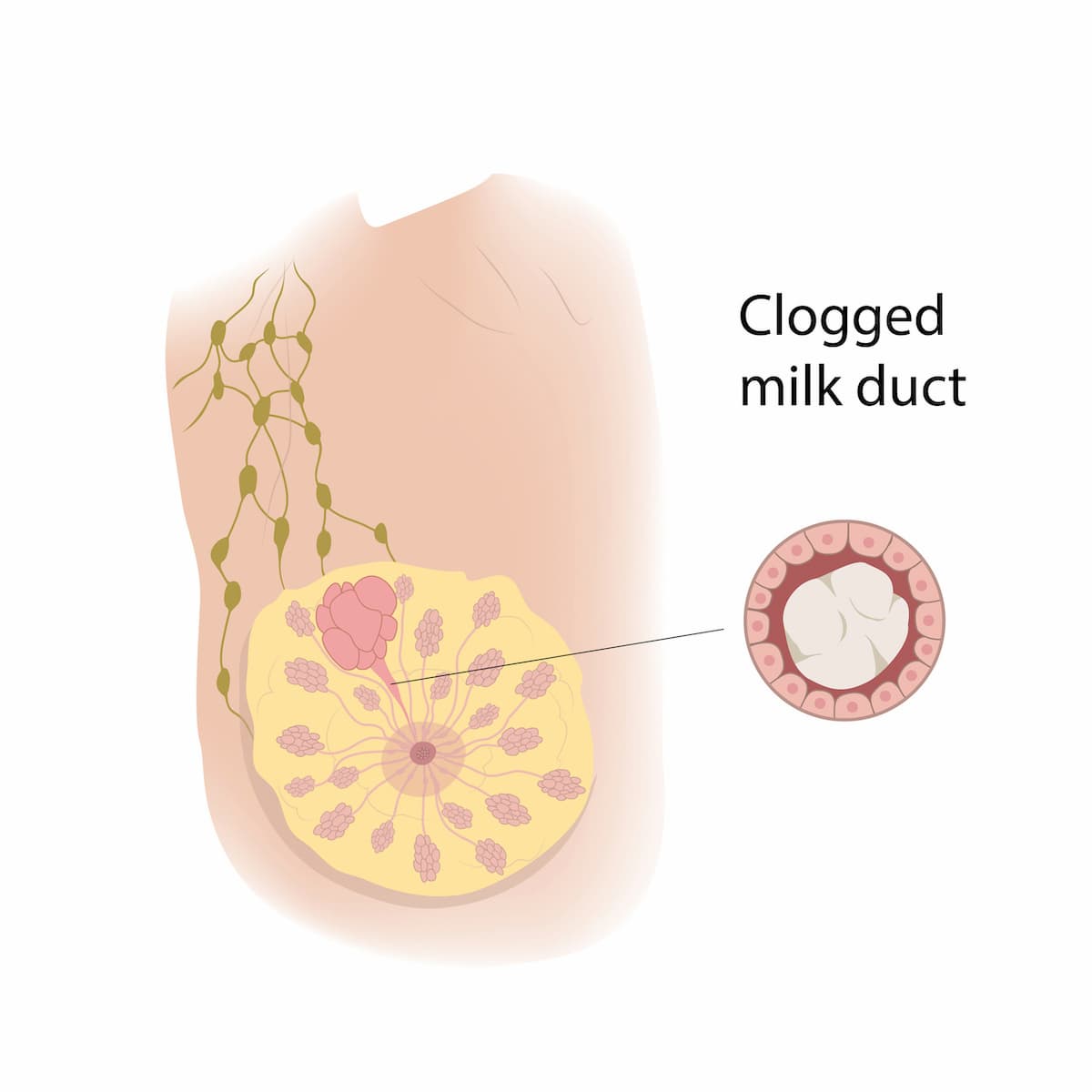 clogged milk duct