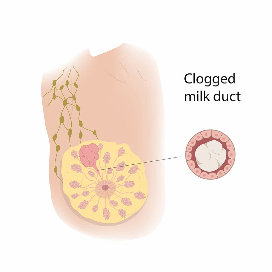 Ilustración de un conducto de leche obstruido